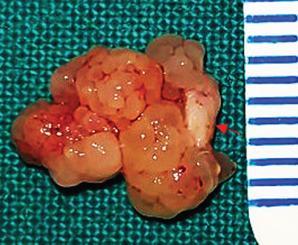 Post-excision of papilloma; arrow indicating the attachment site (red arrow).